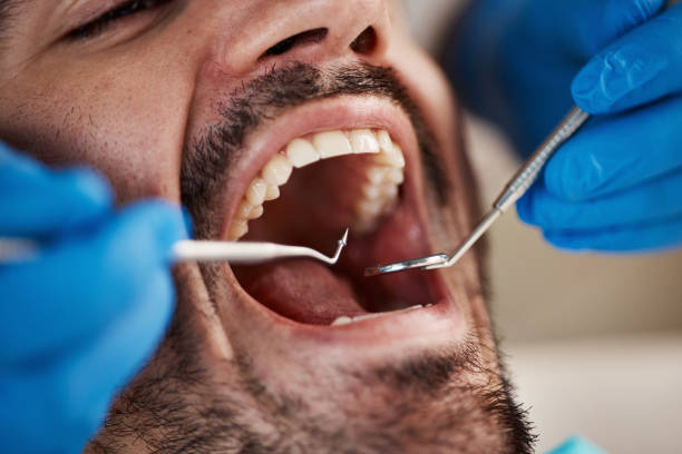 Best Emergency Wisdom Tooth Extraction in Beulaville, NC